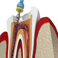 Procedimiento dental para tratar una muela picada, mostrando la limpieza del conducto radicular con una lima.