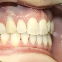 Dientes sanos y encías rosadas, sin signos de poner encías retraídas.