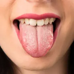 Boca abierta mostrando lengua rosada con pequeñas manchas rojas, reflejo de la ansiedad en la boca.