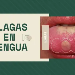 Una llaga con pus en la lengua, destacada en un gráfico que dice "LLAGAS EN LENGUA".
