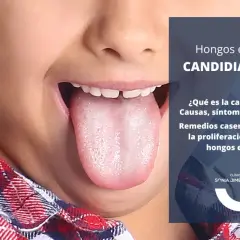 Primer plano de una lengua con aspecto blanquecino, indicando candidiasis oral. El texto informa sobre causas, síntomas y tratamiento.