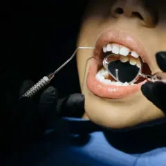 Revisión dental: se me ha roto una muela pero no me duele. El dentista usa un espejo para examinar mi boca.