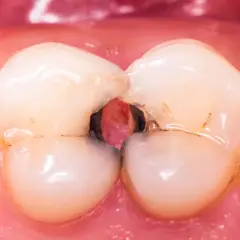 Caries severa en la arcada dental inferior, con cavidades profundas entre los dientes.