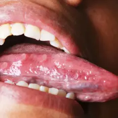 Boca abierta mostrando la lengua con múltiples llagas blancas y rojas, una llaga en la lengua que no se cura.