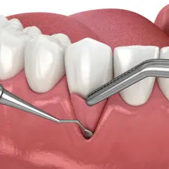 Ilustración dental que muestra el inicio de un trasplante de encía, con instrumentos quirúrgicos listos para el procedimiento.