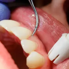 Detalles de un tratamiento dental para como tratar la gingivitis. Un dentista usa un scaler para limpiar los dientes.