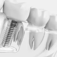Detalle de implantes dentales tornillos, mostrando su integración en el hueso y la corona dental.