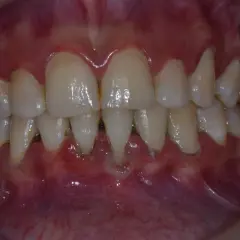 Encías inflamadas y dientes con sarro, signos de periodontitis avanzada, a menudo agravada por el tabaco.