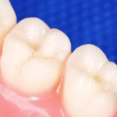 Detalle de una muela con una fisura fina. Aprende como arreglar una fisura en la muela para mantener tu sonrisa sana.