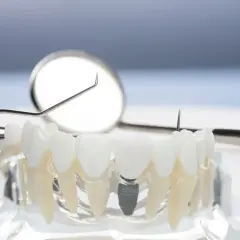 Modelo dental con implantes osteointegrados, mostrando la integración de un implante en la mandíbula, junto a herramientas dentales.