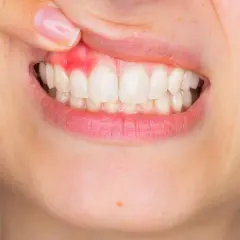Encía inflamada y enrojecida, mostrando un posible flemón sin dolor. Dientes blancos y sanos.