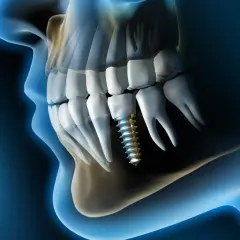 Implante dental en el hueso maxilofacial, mostrando la estructura ósea y los dientes.