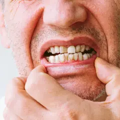 Primer plano de la boca de un hombre, mostrando un diente roto y otros dientes desgastados.