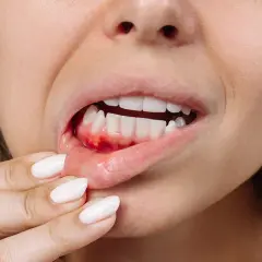 Una persona se toca la encía inflamada y con sangrado dental, mostrando los dientes blancos.