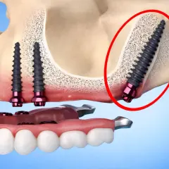 Implantes dentales en el hueso maxilar, uno de ellos en el área del hueso pterigoides, con una prótesis dental.