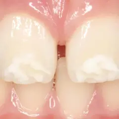 Manchas blancas en las muelas, que no son caries, se ven en los dientes frontales.