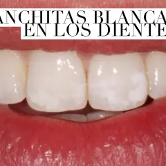 Primer plano de una boca mostrando dientes con manchas blancas.