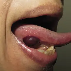 Ampolla oscura y abultada debajo de la lengua, con la lengua extendida.