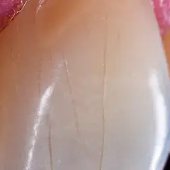 Detalle de dientes con finas líneas verticales que sugieren una infracción del esmalte.