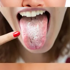 Lengua blanca y llagas visibles, con una uña roja señalando la zona afectada.