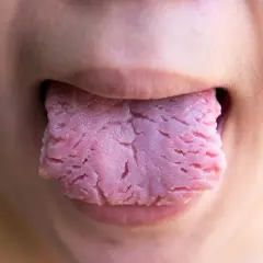 Lengua rosada con surcos profundos y aspecto rugoso, similar a llagas rojas en la lengua, asomando entre los labios.