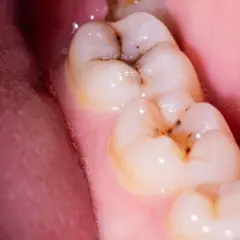 Muelas con caries y empastes. Se observa una muela picada con restos de comida y un empaste dental.