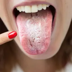 Dedo con uña roja señala una lengua con una llaga blanca, indicando posible candidiasis oral.