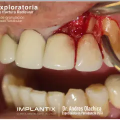Exploración dental muestra una fractura radicular con tejido de granulación y pérdida ósea vestibular.