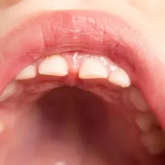 Boca de niño con dientes frontales que muestran signos de hipocalcificación del esmalte, con un aspecto opaco y ligeramente amarillento.