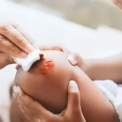 Mano limpia una herida en la rodilla de un niño con clorhexidina, cuidando las pequeñas lesiones.