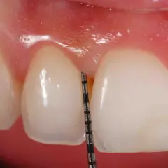 Una sonda dental mide el surco gingival. La gingivitis es contagiosa al besar, así que cuida tu salud bucal.