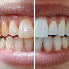 Comparación de dientes: antes amarillentos y después blancos y brillantes, mostrando cómo reforzar el esmalte dental.