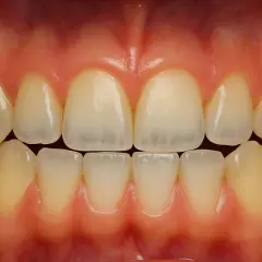 Vista frontal de una boca con dientes sanos y encías rosadas. Se aprecian los incisivos y caninos superiores e inferiores, mostrando una dentadura completa y sin signos de dientes porosos.