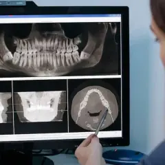 Dentista revisa radiografías dentales, incluyendo una vista panorámica y cortes transversales, para evaluar la necesidad de una elevación de seno maxilar que duele.