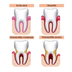 Ilustración muestra la progresión de la enfermedad periodontal, desde encía sana hasta periodontitis severa, con posible pérdida de dientes.