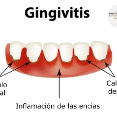 Ilustración de gingivitis con cálculo dental y encias muy inflamadas.
