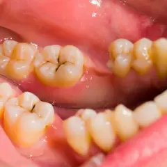 Vista de cerca de dientes con manchas marrones por dentro, mostrando caries y empastes.