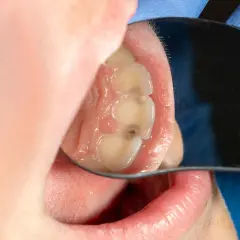 Vista de caras interproximales de los dientes, con caries visibles en algunas zonas.