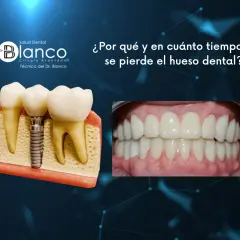 Modelo dental muestra implante y dientes. Foto de sonrisa perfecta. Información sobre cómo recuperar hueso encias.