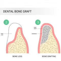 Ilustración del proceso de injerto óseo dental: extracción, pérdida ósea, injerto y colocación de implante para recuperar hueso dental.