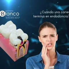 Una mujer con dolor de muelas mira un modelo dental que muestra una caries profunda. ¿Qué pasa si una caries llega al nervio?