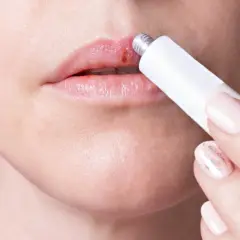 Aplicando crema para el herpes labial en un labio con una lesión.