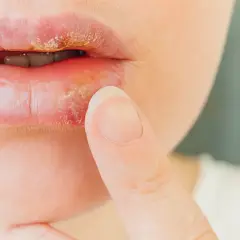 Labios con herpes, señal de defensas bajas. Una persona se toca el labio afectado.
