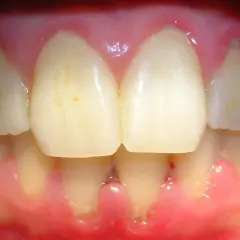 Encías inflamadas y enrojecidas, con signos de gingivitis por estrés. Se observan dientes con manchas y la línea de la encía retraída en algunas zonas.