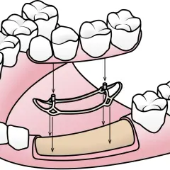 Si no tienes hueso para implante dental, una prótesis parcial removible como esta puede ser tu solución.