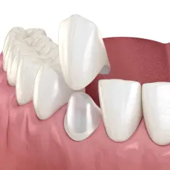 Coronas de disilicato de litio listas para ser colocadas en los dientes, mejorando la estética dental.