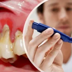 Dientes con caries y encías inflamadas, junto a un hombre midiéndose el azúcar. La diabetes puede empeorar la salud bucal.