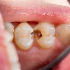 Vista de cerca de una muela con una caries visible. Se aprecian los dientes sanos y la cavidad oscura de la caries.