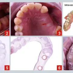 Guía quirúrgica para implantes dentales, planificando un puente dental en los dientes delanteros.