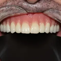 Una dentadura sin dientes, con encías rosadas y dientes postizos blancos y perfectos, se muestra en primer plano.